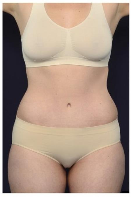 After image 1 Case #87556 - Abdominoplasty
