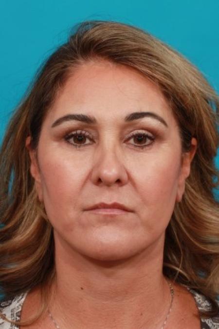 After image 1 Case #86041 - Neck Lift AFTER Kybella