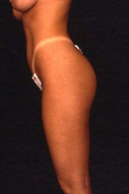 After image 2 Case #81521 - Liposuction