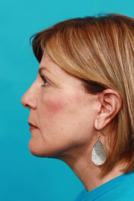 After image 3 Case #85636 - Face Lift with Upper Blepharoplasty