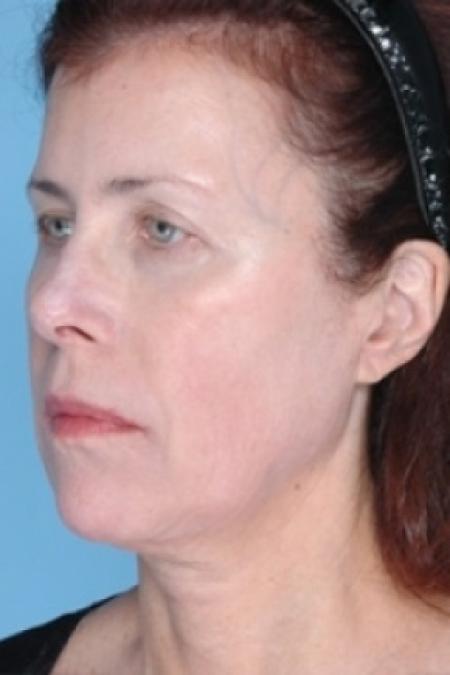 After image 1 Case #79311 - Non-Surgical Focused Ultrasound