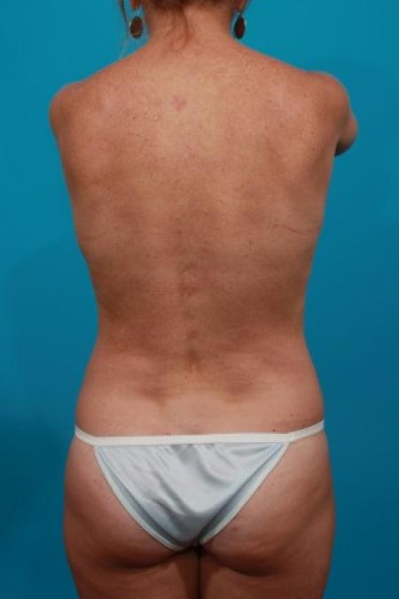 After image 2 Case #84001 - Flank Liposuction
