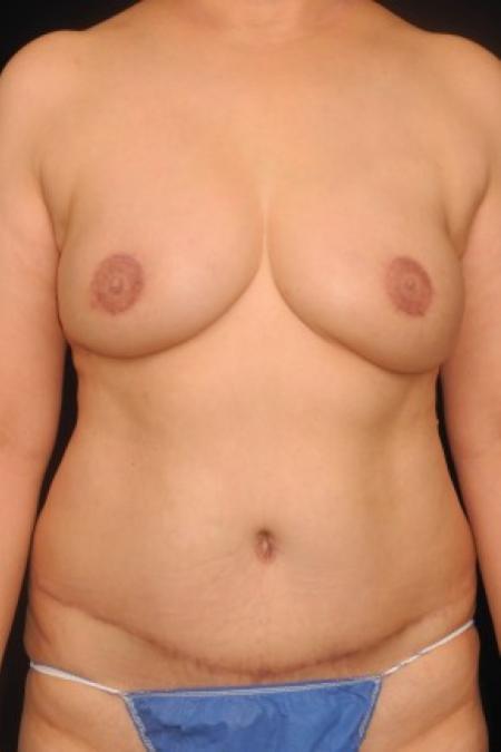 After image 1 Case #82961 - 52 y/o - Immediate DIEP Flap Breast Reconstruction