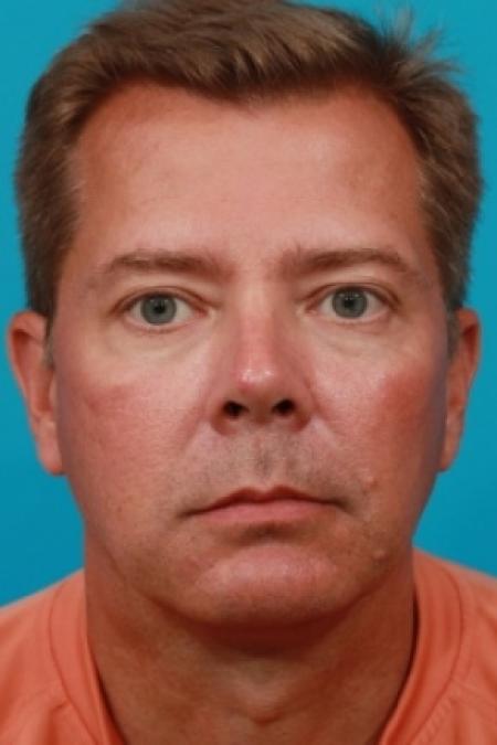 After image 1 Case #78866 - Lower Blepharoplasty