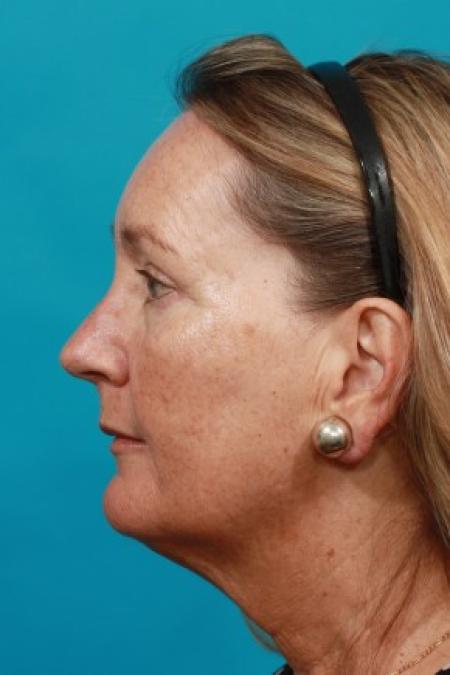 After image 3 Case #86036 - Quad Blepharoplasty