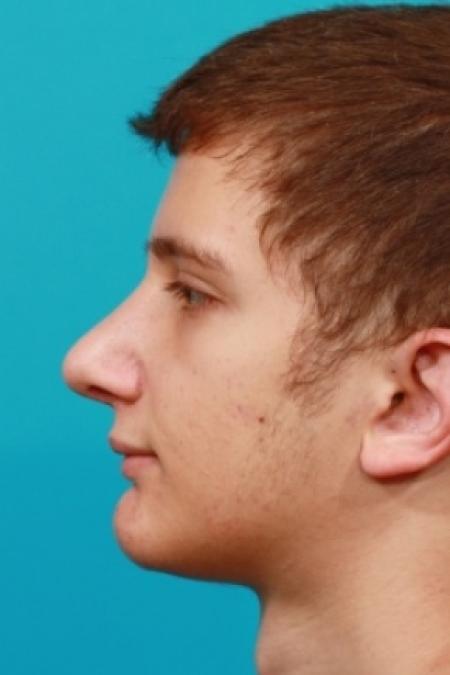After image 3 Case #78766 - Rhinoplasty (Nose Reshaping)