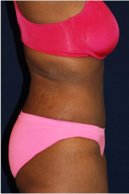 After image 3 Case #84951 - Abdominoplasty