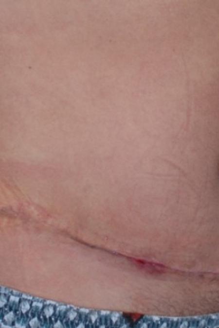 After image 2 Case #81181 - Abdominoplasty and Liposuction