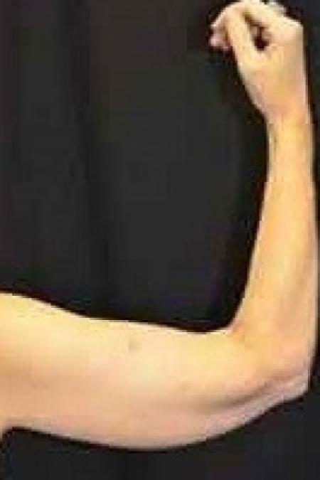 After image 2 Case #85661 - Upper Arm Lift 