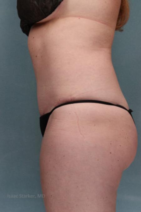 After image 2 Case #88161 - Tummy Tuck