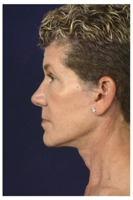 After image 3 Case #84391 - Full Facial Rejuvenation