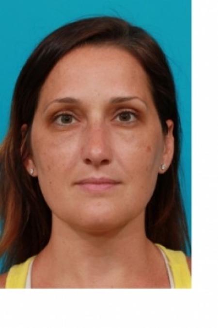 After image 1 Case #81066 - Open Rhinoplasty