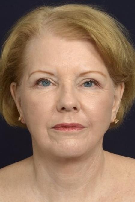 After image 1 Case #87141 - Full Facial Rejuvenation