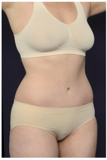 After image 2 Case #87556 - Abdominoplasty