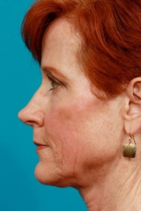 After image 2 Case #78911 - Upper Blepharoplasty
