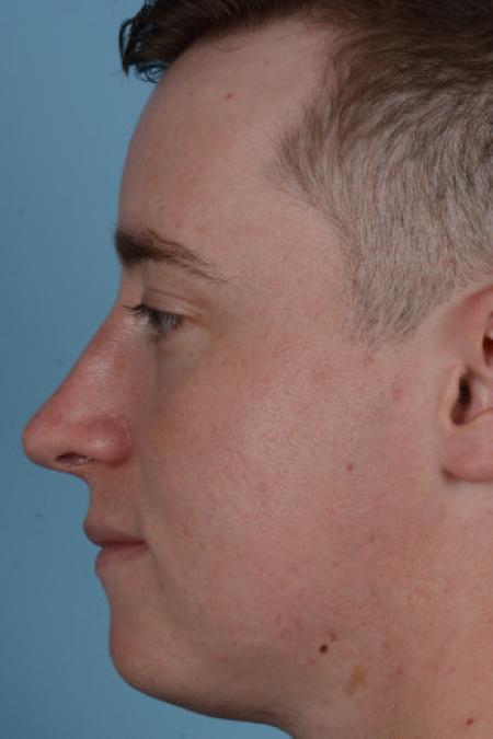 After image 2 Case #88291 - Male Rhinoplasty