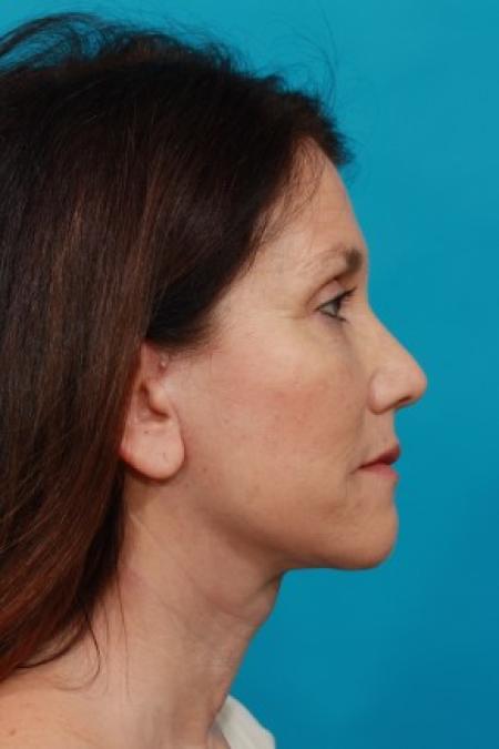 After image 3 Case #84011 - Neck Lift