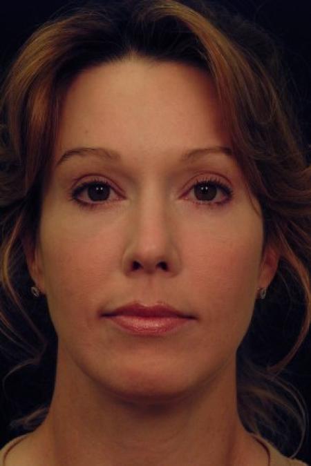 After image 1 Case #87661 - Full Facial Rejuvenation