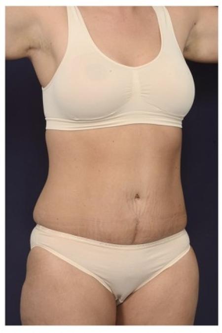 After image 2 Case #84511 - Abdominoplasty