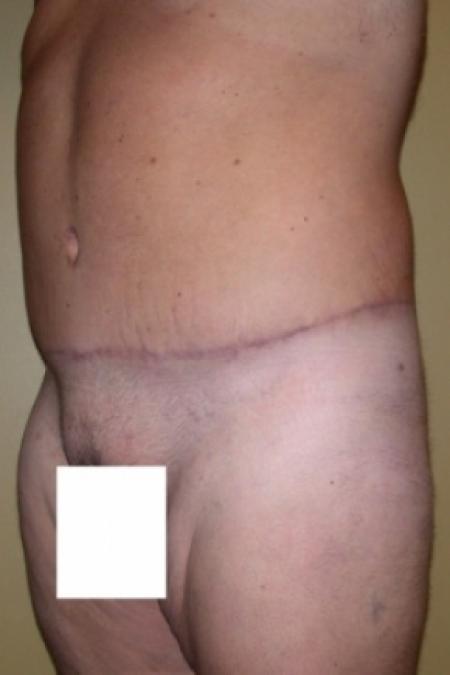 After image 2 Case #79796 - Male Tummy Tuck