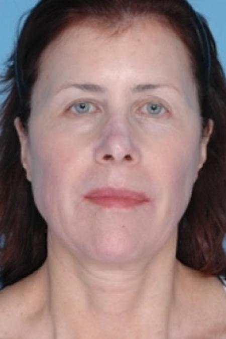 After image 1 Case #79306 - Non-Surgical Focused Ultrasound