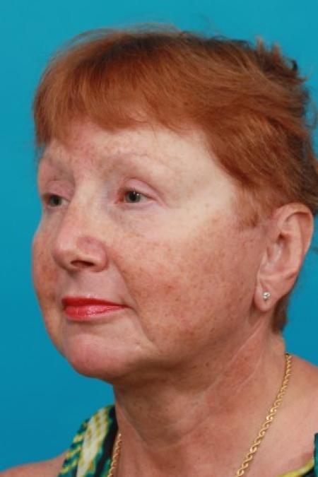 After image 2 Case #83001 - Facial Rejuvenation