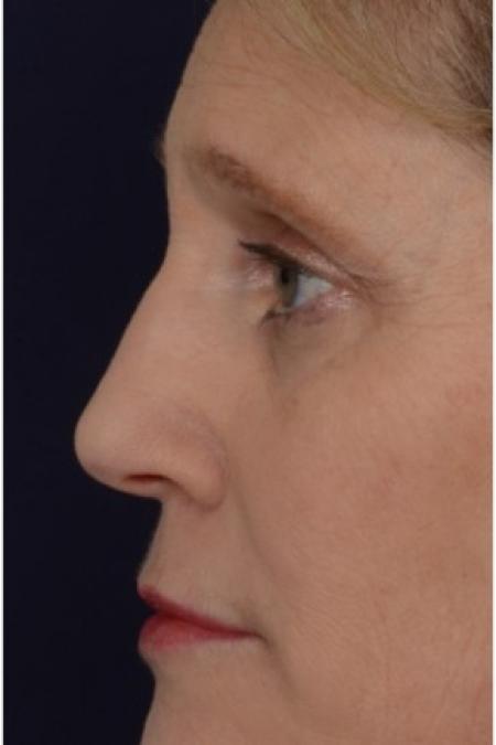 After image 2 Case #86316 - 50 year old woman treated with nonsurgical rhinoplasty