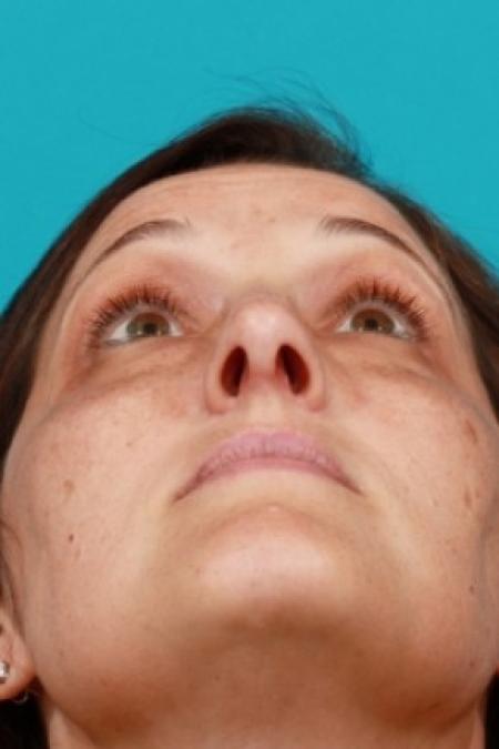 After image 4 Case #81066 - Open Rhinoplasty