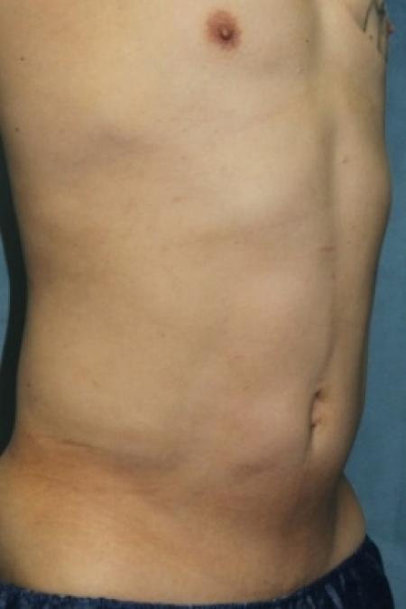 After image 2 Case #80846 - Liposuction