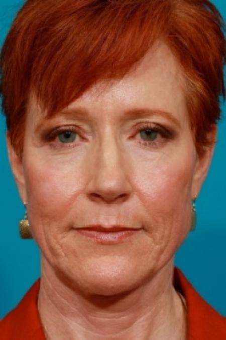 After image 1 Case #78911 - Upper Blepharoplasty