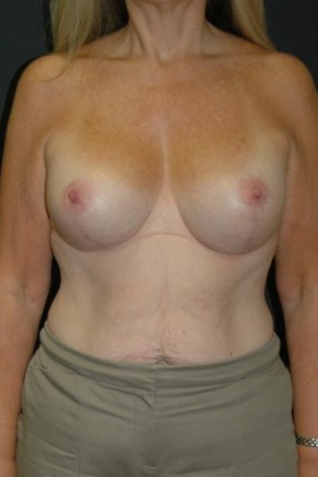 After image 1 Case #81306 - Mastopexy with Breast Augmentation using Sientra MP-485cc