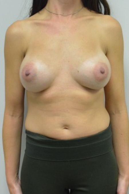After image 1 Case #88086 - 34-44 year old woman treated with breast augmentation using Ideal Implants