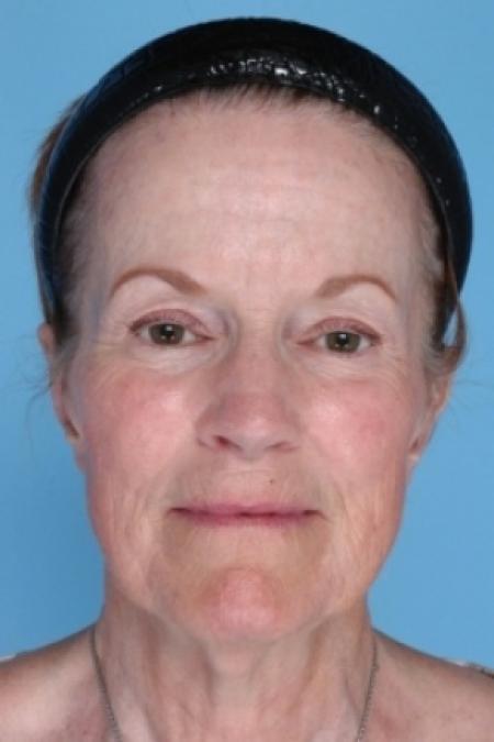 After image 1 Case #80581 - Otoplasty with Earlobe Reduction