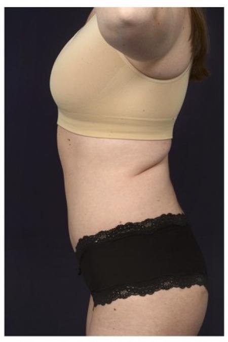After image 3 Case #85561 - Abdominoplasty