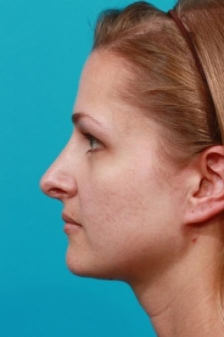 After image 3 Case #78781 - Rhinoplasty (Nose Reshaping)