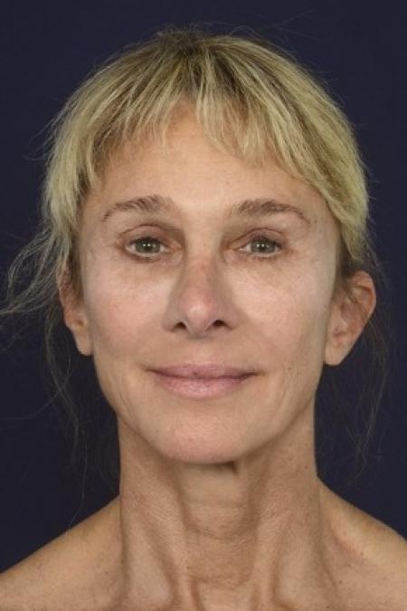 After image 1 Case #87126 - Structural Fat Grafting