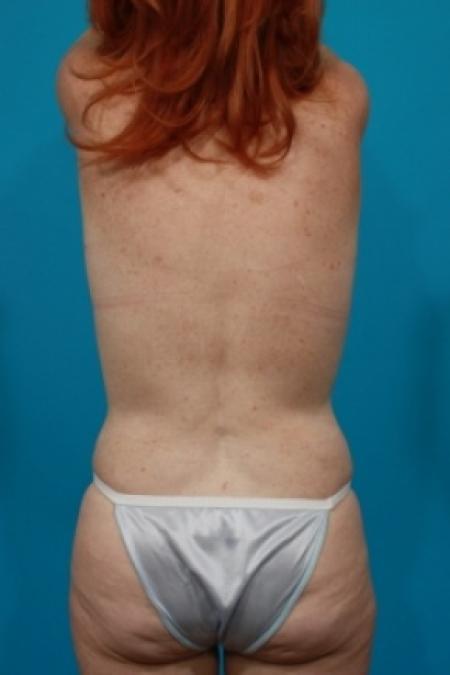 After image 5 Case #80461 - Mommy Makeover