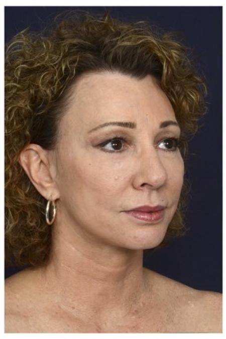 After image 2 Case #86276 - 50 year old woman treated with Full Facial Rejuvenation