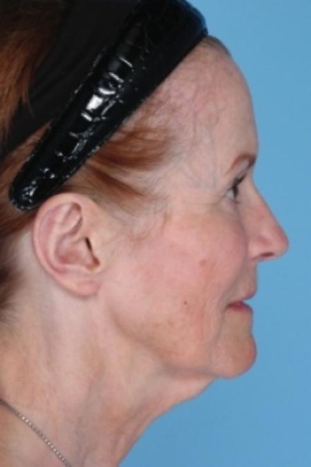 After image 2 Case #80581 - Otoplasty with Earlobe Reduction