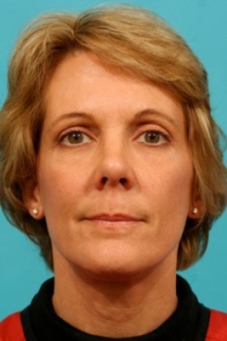 After image 1 Case #78936 - Facial Rejuvenation