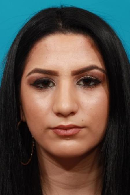 After image 1 Case #83921 - Rhinoplasty with Chin Augmentation