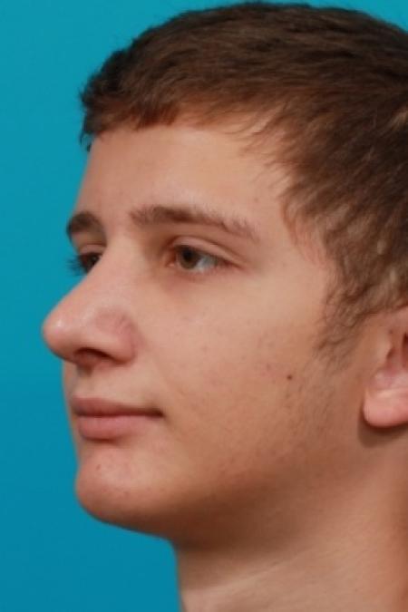 After image 2 Case #78766 - Rhinoplasty (Nose Reshaping)