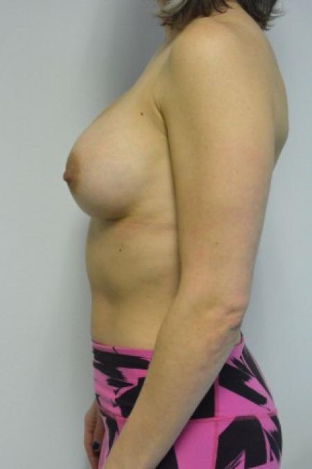 After image 3 Case #88091 - 34-44 year woman treated with microtextured high profile cohesive silicone gel implants.  