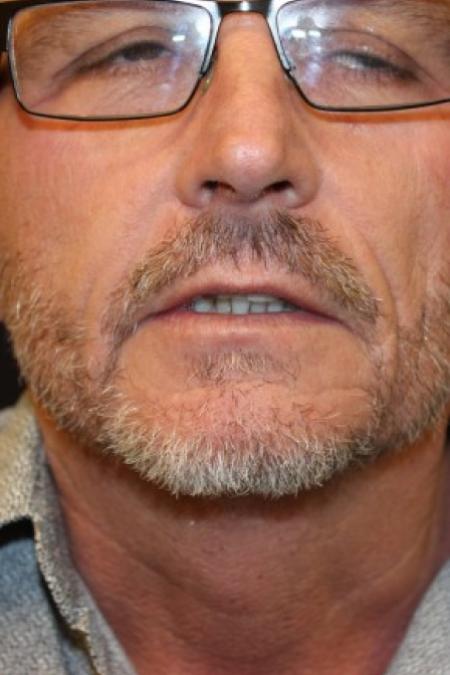After image 1 Case #87371 - Hair Transplantation San Diego