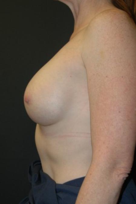 After image 3 Case #81316 - Breast Augmentation using Allergan Style 15- 286cc