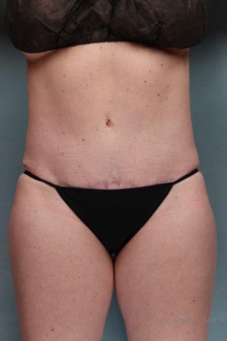 After image 1 Case #88161 - Tummy Tuck