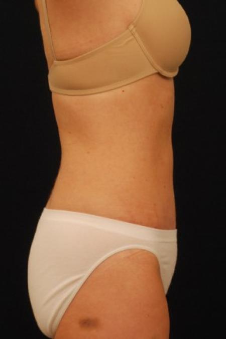 After image 3 Case #87681 - Abdominoplasty
