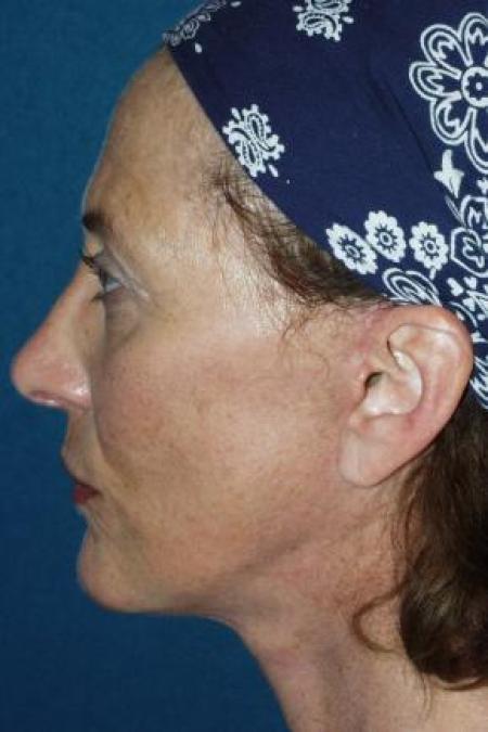 After image 3 Case #80911 - Facelift