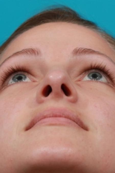 After image 4 Case #78781 - Rhinoplasty (Nose Reshaping)