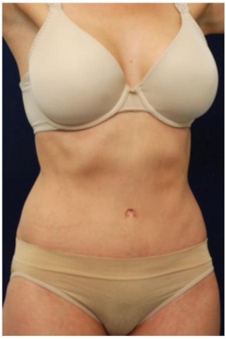 After image 2 Case #82081 - Tummy Tuck